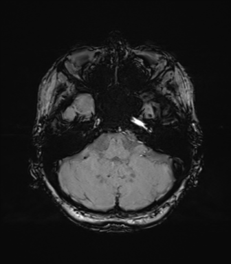 Anaplastic astrocytoma (Radiopaedia 86943-103160 Axial SWI 23).png