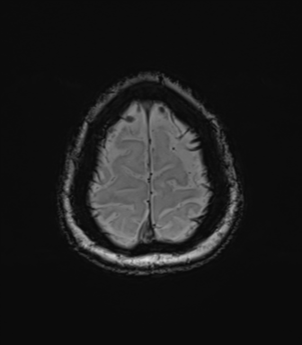 Anaplastic astrocytoma (Radiopaedia 86943-103160 Axial SWI 80).png