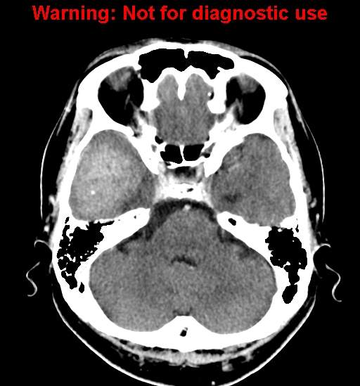 File:Anaplastic ganglioglioma (Radiopaedia 44921-48815 B 8).jpg