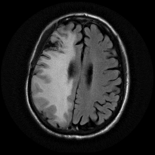 File:Anaplastic meningioma with recurrence (Radiopaedia 34452-35790 Axial T2 FLAIR 15).png