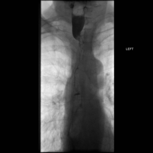 File:Anastomotic stricture post Ivor Lewis esophagectomy (Radiopaedia 47937-52715 B 20).png