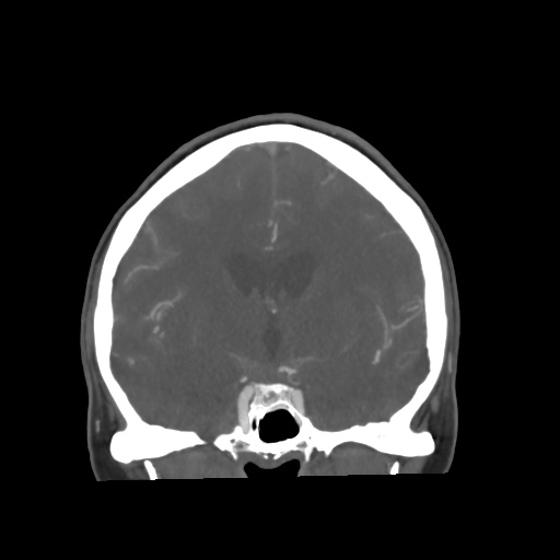 File:Aneursym related subarachnoid hemorrhage with hydrocephalus (Radiopaedia 45105-49084 B 38).jpg