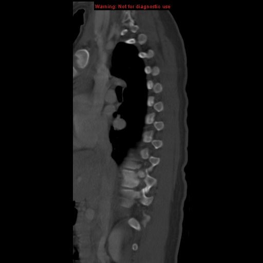 File:Aneurysmal bone cyst (Radiopaedia 9419-10102 Sagittal bone window 1).jpg
