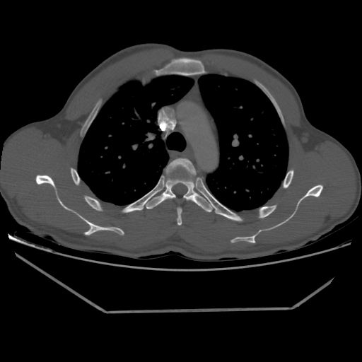 Aneurysmal bone cyst - rib (Radiopaedia 82167-96220 Axial bone window 100).jpg