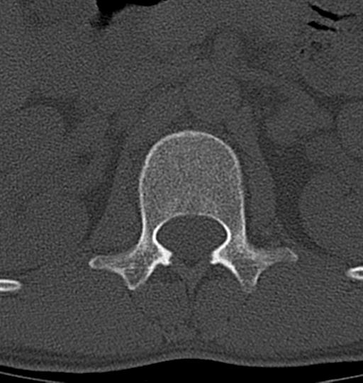 Aneurysmal bone cyst T11 (Radiopaedia 29294-29721 Axial bone window 63).jpg