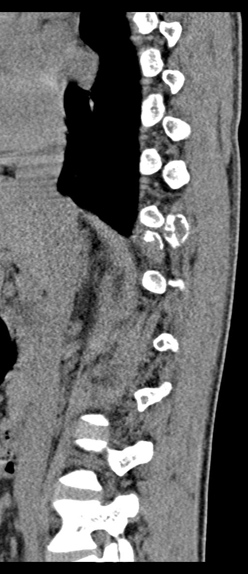 Aneurysmal bone cyst T11 (Radiopaedia 29294-29721 E 55).jpg