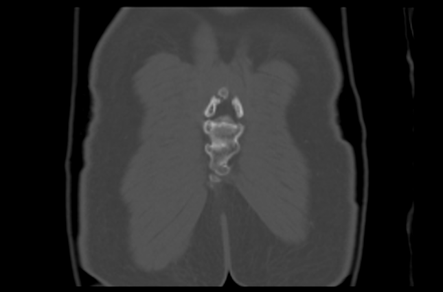 File:Aneurysmal bone cyst of ischium (Radiopaedia 25957-26094 Coronal bone window 45).png