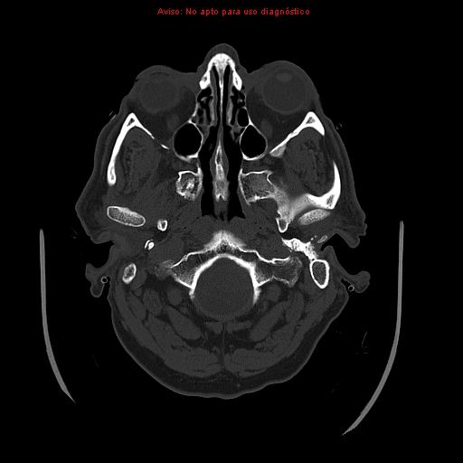 File:Aneurysmal subarachnoid hemorrhage (Radiopaedia 24740-24997 bone window 3).jpg
