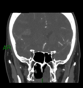 Aneurysmal subarachnoid hemorrhage with intra-axial extension (Radiopaedia 84371-99732 C 65).jpg