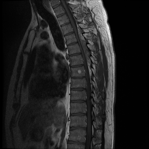 File:Angiolipoma - thoracic spine (Radiopaedia 28242-28479 Sagittal T1 7).jpg