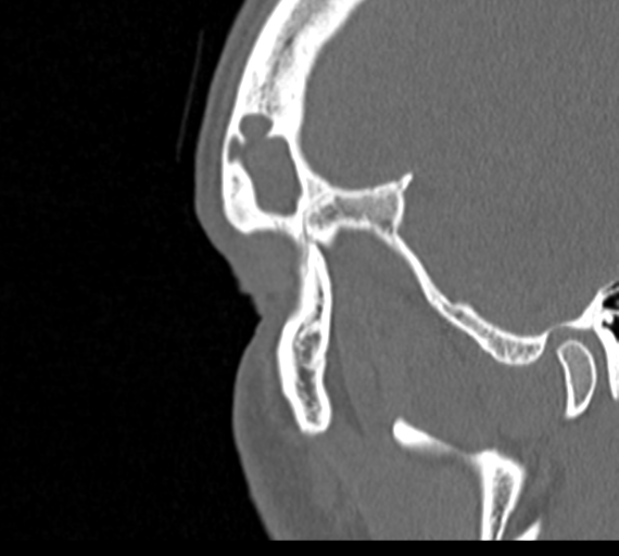 Angular epidermoid cyst (Radiopaedia 46908-51439 Sagittal bone window 89).png