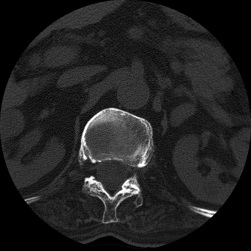 Ankylosing spondylitis complicated by fracture-dislocation (Radiopaedia 33583-34674 Axial non-contrast 6).jpg