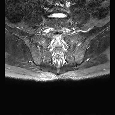 File:Ankylosing spondylitis with zygapophyseal arthritis (Radiopaedia 38433-40517 D 10).jpg