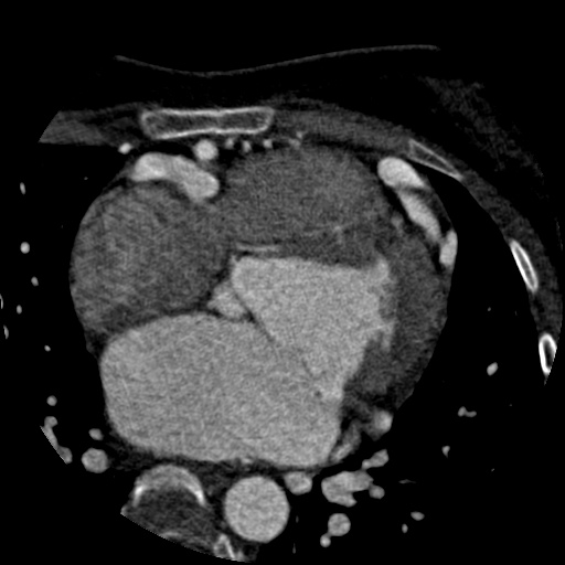 File:Anomalous left coronary artery from the pulmonary artery (ALCAPA) (Radiopaedia 40884-43586 A 35).jpg