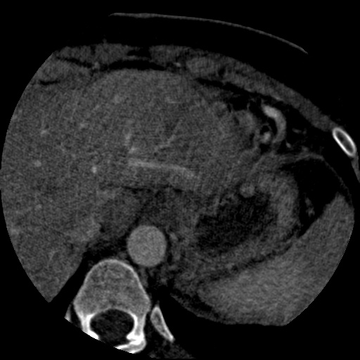 Anomalous left coronary artery from the pulmonary artery (ALCAPA) (Radiopaedia 40884-43586 A 88).jpg
