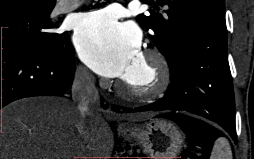 Anomalous left coronary artery from the pulmonary artery (ALCAPA) (Radiopaedia 70148-80181 B 195).jpg