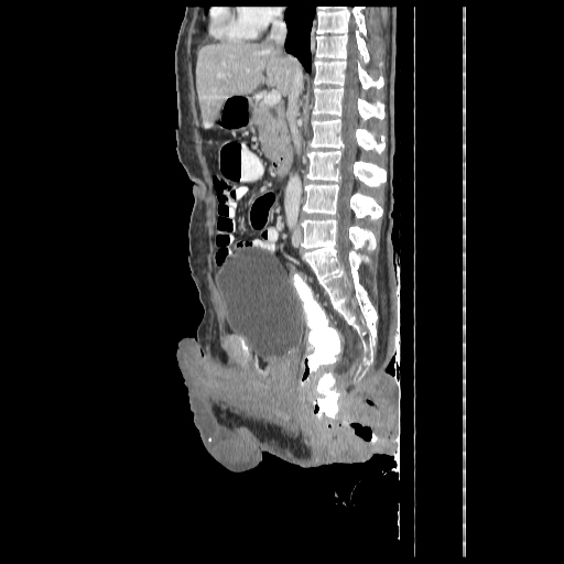 Anorectal carcinoma (Radiopaedia 44413-48064 C 52).jpg