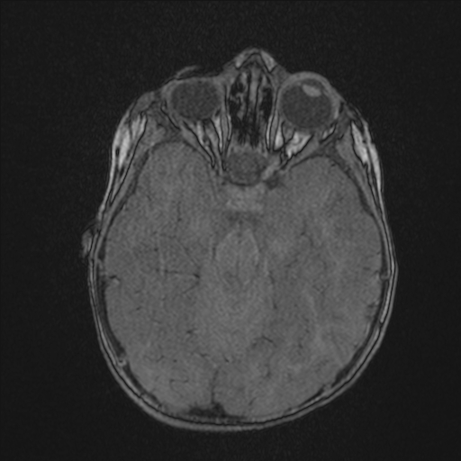 Anoxic brain injury (Radiopaedia 79165-92139 Axial MRA 81).jpg