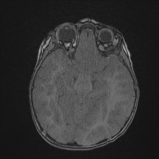 Anoxic brain injury (Radiopaedia 79165-92139 Axial MRA 96).jpg