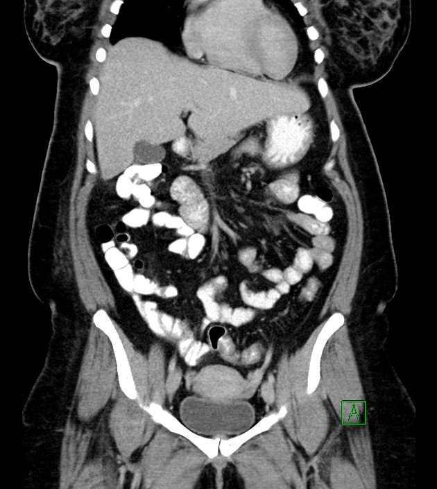 Anterior abdominal wall CSF pseudocyst (CSFoma) (Radiopaedia 79453-92571 B 23).jpg