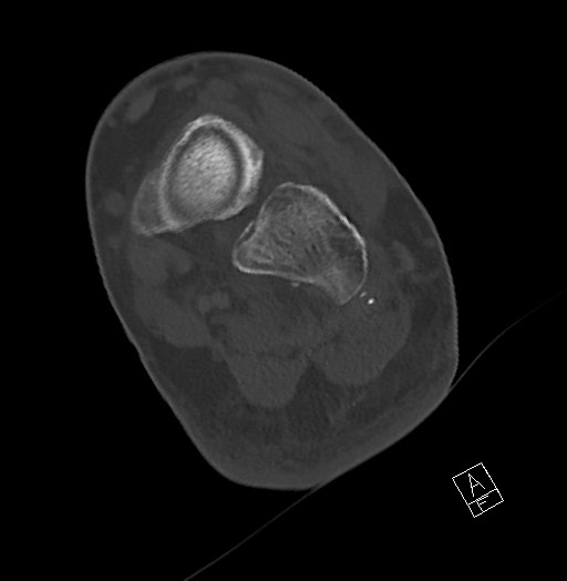 Anterior calcaneal process fracture (Radiopaedia 63353-71943 Axial bone window 89).jpg