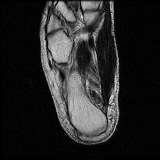 File:Anterior calcaneal process fracture (Radiopaedia 71377-81705 Axial T2 15).jpg