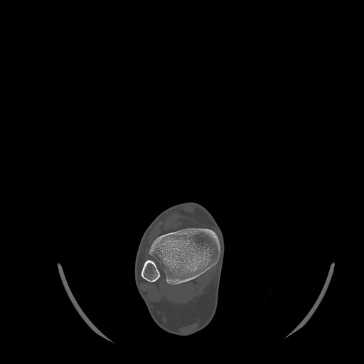 Anterior calcaneal process fracture (Radiopaedia 82590-96762 Axial bone window 8).jpg