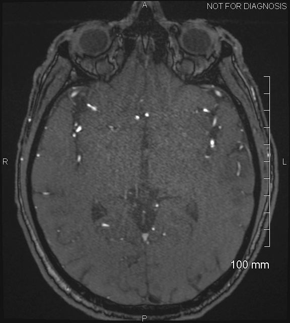 Anterior cerebral artery aneurysm (Radiopaedia 80683-94127 Axial MRA 115).jpg
