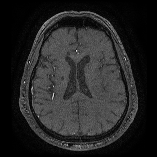 Anterior cerebral artery infarction (Radiopaedia 46794-51323 Axial MRA 137).jpg
