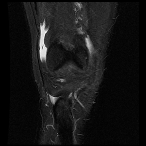 File:Anterior cruciate ligament avulsion fracture (Radiopaedia 58939-66193 Coronal STIR 5).jpg