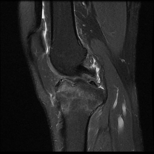 File:Anterior cruciate ligament avulsion fracture (Radiopaedia 58939-66193 Sagittal PD fat sat 13).jpg