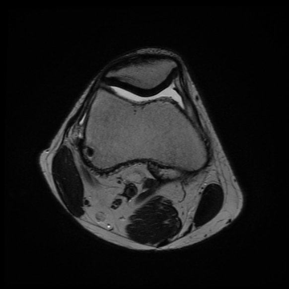 File:Anterior cruciate ligament graft tear and bucket-handle tear of medial meniscus (Radiopaedia 75867-87254 Axial T2 20).jpg