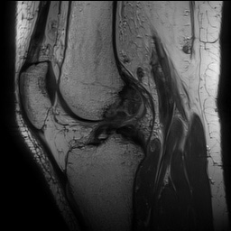Anterior cruciate ligament rupture with Segond fracture (Radiopaedia 69043-78806 Sagittal PD 103).jpg