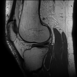 Anterior cruciate ligament rupture with Segond fracture (Radiopaedia 69043-78806 Sagittal PD 120).jpg