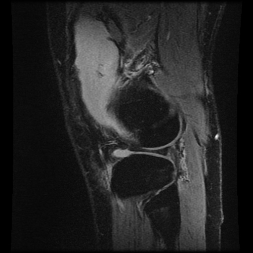 Anterior cruciate ligament tear (Radiopaedia 61500-69462 F 77).jpg