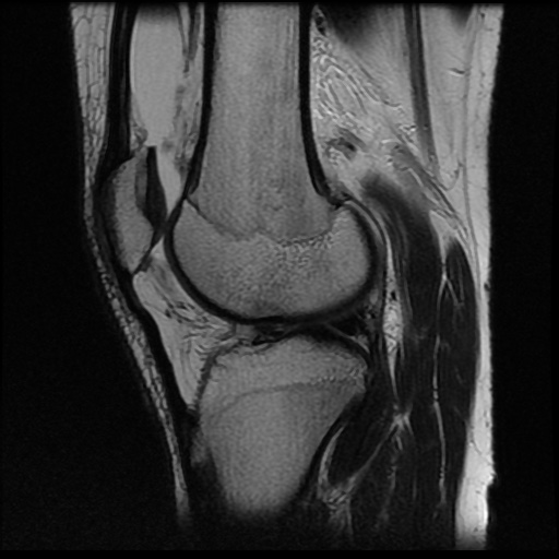 File:Anterior cruciate ligament tear (Radiopaedia 61500-69462 Sagittal T2 13).jpg