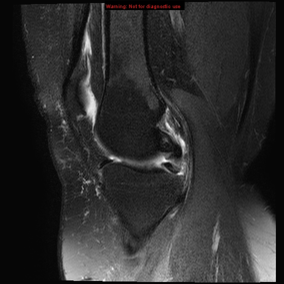 File:Anterior cruciate ligament tear - complete (Radiopaedia 12175-12514 Sagittal T2 fat sat 14).jpg
