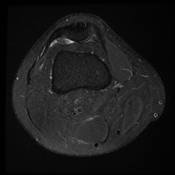 File:Anterior cruciate ligament tear with posteromedial corner injury, bucket-handle meniscal tear and chondral delamination (Radiopaedia 75501-86744 Axial PD fat sat 23).jpg