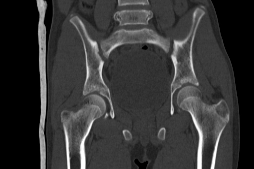 Anterior inferior iliac spine avulsion injury (Radiopaedia 88666-105376 Coronal bone window 39).jpg