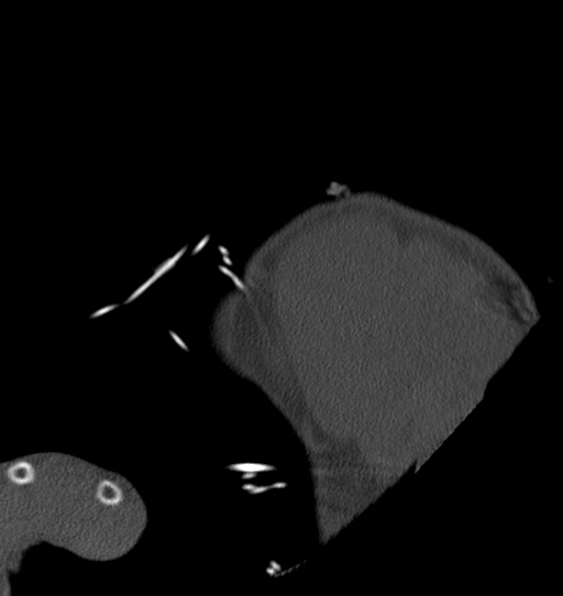 Anterior shoulder dislocation with Hill-Sachs and bony Bankart lesions (Radiopaedia 40424-42974 Sagittal bone window 5).png