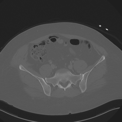 Anterior superior iliac spine avulsion fracture (Radiopaedia 44541-48244 Axial bone window 73).png