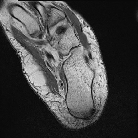 File:Anterior talofibular ligament injury - rupture with soft-tissue impingement (Radiopaedia 38765-40928 Axial PD 30).jpg