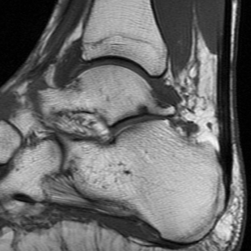 File:Anterior talofibular ligament rupture (Radiopaedia 15831-15484 Sagittal T1 10).jpg