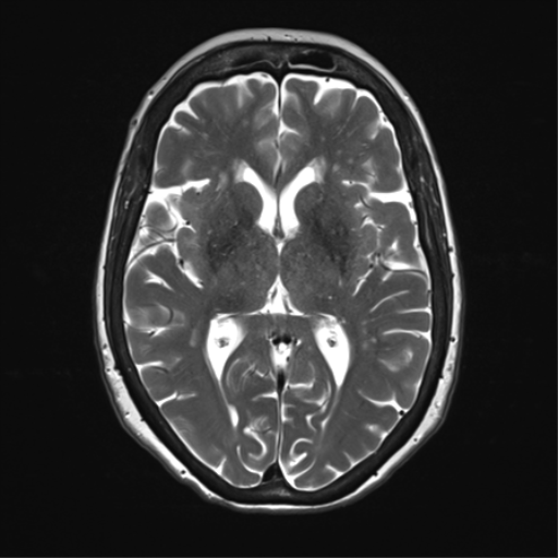 File:Anterior temporal pole cysts (Radiopaedia 46629-51102 C 20).png