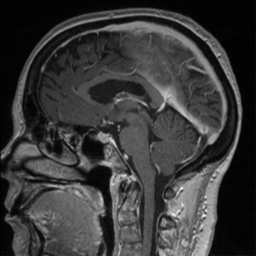 Anterior temporal pole cysts (Radiopaedia 46629-51102 Coronal T1 C+ 175).png