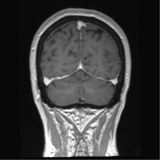 Anterior temporal pole cysts (Radiopaedia 46629-51102 Coronal T1 C+ 40).png