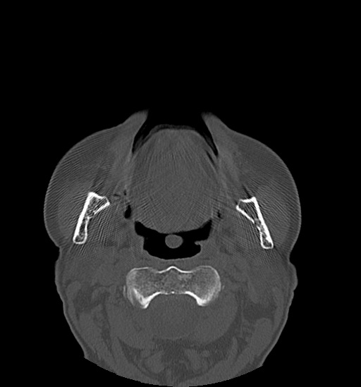 Anterior temporomandibular joint dislocation (Radiopaedia 59430-66784 Axial non-contrast 35).jpg