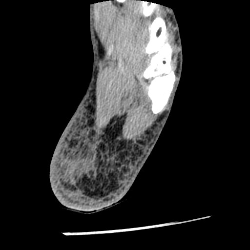 Anterior tibial artery false aneurysm (Radiopaedia 88984-105809 A 230).jpg