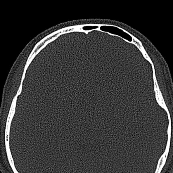 Antrochoanal polyp (Radiopaedia 30002-30554 Axial bone window 60).jpg