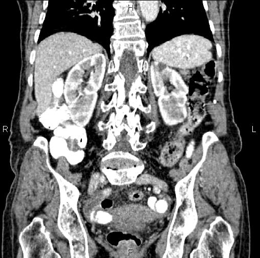 File:Aortic aneurysm and Lemmel syndrome (Radiopaedia 86499-102554 C 44).jpg